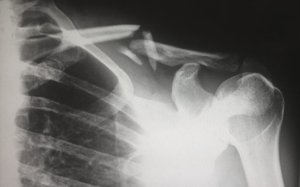 XRAY image of broken collar bone.