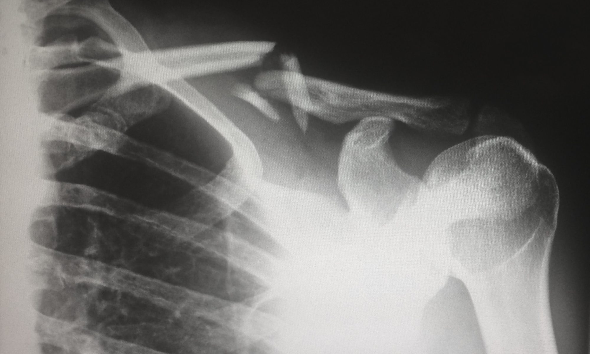 XRAY image of broken collar bone.